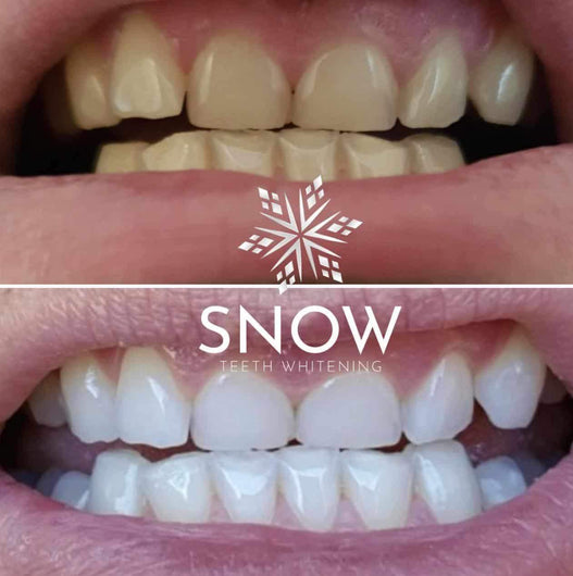 *July 4th Special* Snow Teeth Whitening Kit + FREE 1-MONTH REFILLS