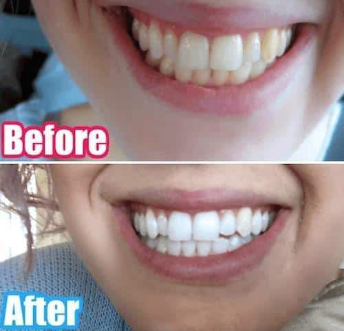 At-Home Teeth Whitener - Bck OFFICIAL All-in-One SNOW Teeth Whitening™ System [SALE]