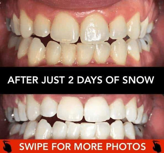 At-Home Teeth Whitener - Bck OFFICIAL All-in-One SNOW Teeth Whitening™ System [SALE]