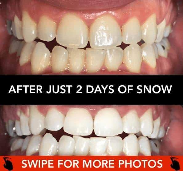 At-Home Teeth Whitener - Bck OFFICIAL All-in-One SNOW Teeth Whitening™ System [SALE]
