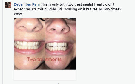 At-Home Teeth Whitener - Bck OFFICIAL All-in-One SNOW Teeth Whitening™ System [SALE]