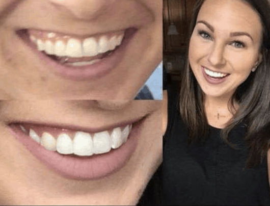 GRONK's Snow Teeth Whitening™ At-Home System [All-in-One Kit]
