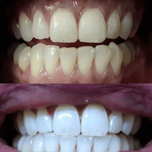 alternative-to-white-strips