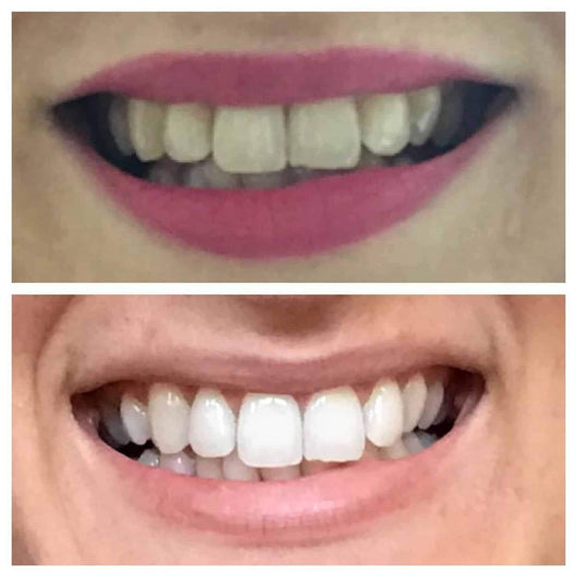 GRONK's Snow Teeth Whitening™ At-Home System [All-in-One Kit]