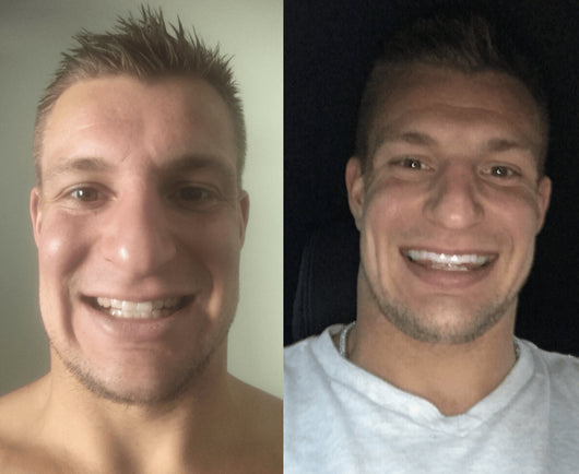 GRONK's Snow Teeth Whitening™ At-Home System [All-in-One Kit]
