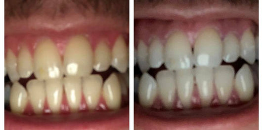 GRONK's Snow Teeth Whitening™ At-Home System [All-in-One Kit]