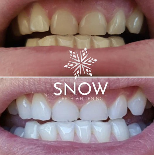 Dual-light, WIRELESS, Self-Sanitizing Snow® Teeth Whitening System