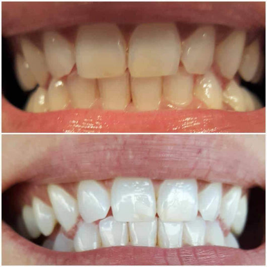 GRONK's Snow Teeth Whitening™ At-Home System [All-in-One Kit]