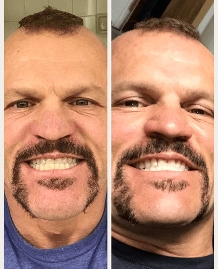 GRONK's Snow Teeth Whitening™ At-Home System [All-in-One Kit]