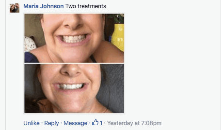 At-Home Teeth Whitener - Bck OFFICIAL All-in-One SNOW Teeth Whitening™ System [SALE]