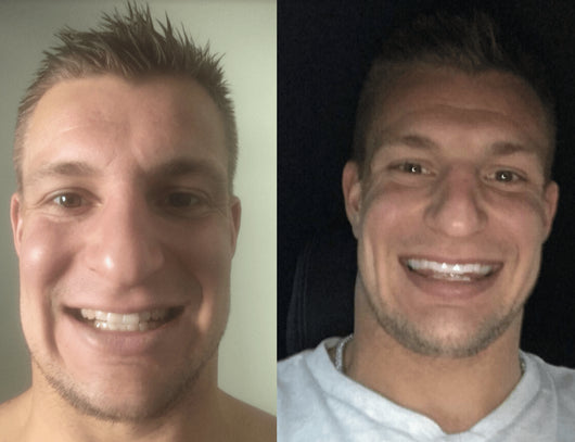 GRONK's Snow Teeth Whitening™ At-Home System [All-in-One Kit]