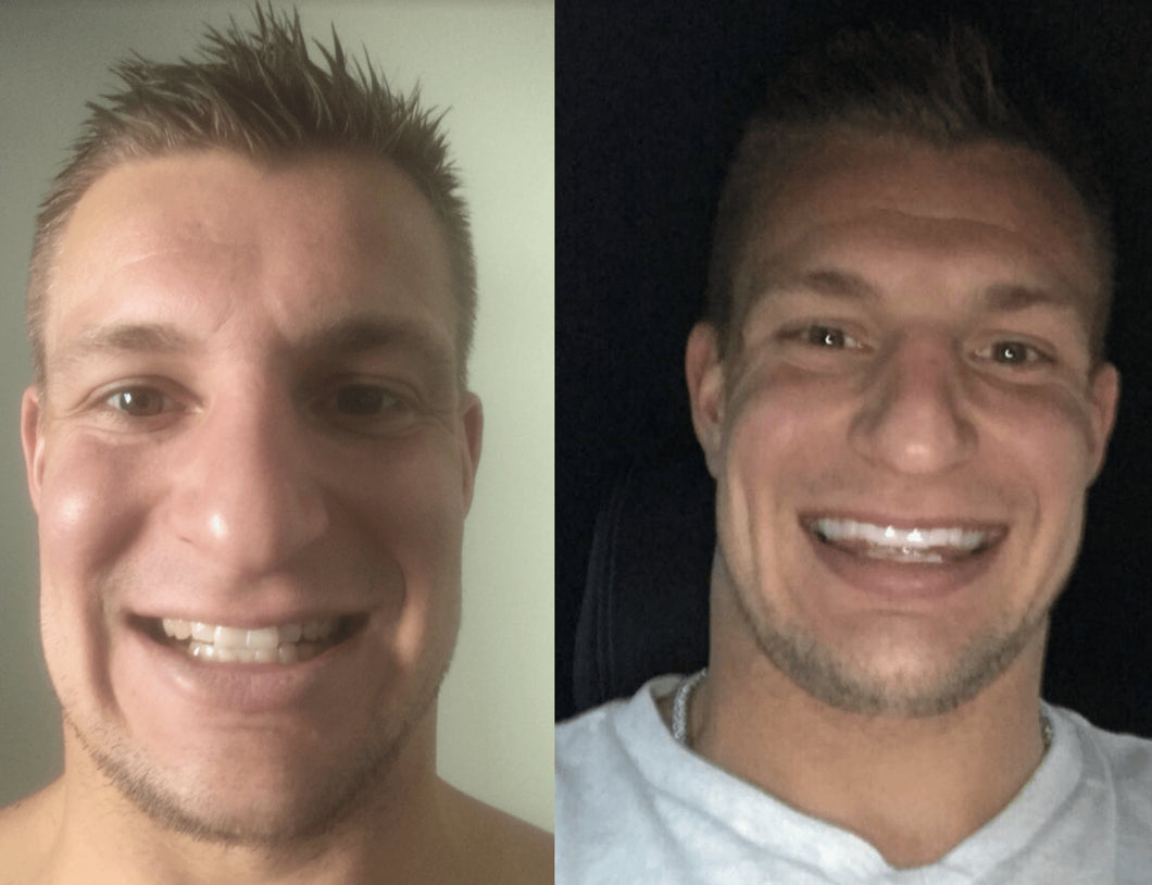 GRONK's Snow Teeth Whitening™ At-Home System [All-in-One Kit]